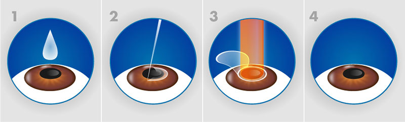 phẫu thuật lasik