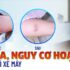 Mất da, nguy cơ hoại tử do bỏng bô xe máy