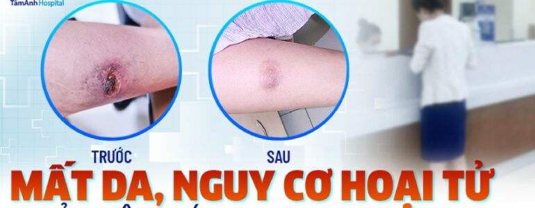 Mất da, nguy cơ hoại tử do bỏng bô xe máy