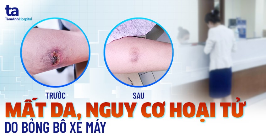 nguy cơ hoại tử da do bỏng bô xe máy