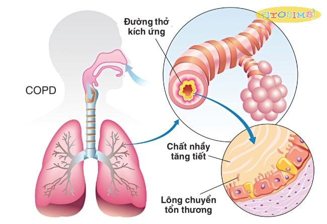 Nguyên nhân gây ho đờm ở trẻ