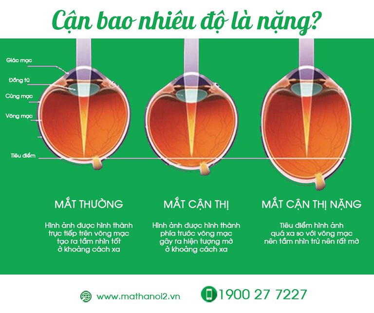 Cận thị bao nhiêu độ là nặng?