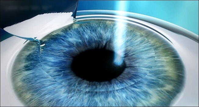 Công nghệ mổ mắt Lasik