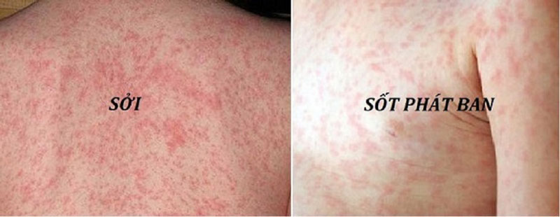 Nhận biết sốt phát ban do virus sởi và sốt phát ban khác