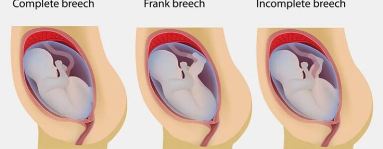 Ngôi thai ngược là gì? Cần làm gì khi được chẩn đoán thai ngôi mông