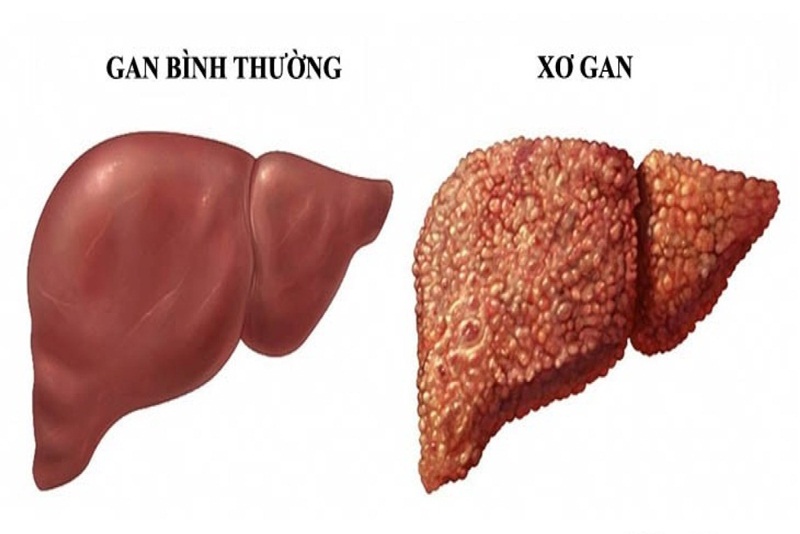 Mắt thâm quầng có thể là dấu hiệu của bệnh gan