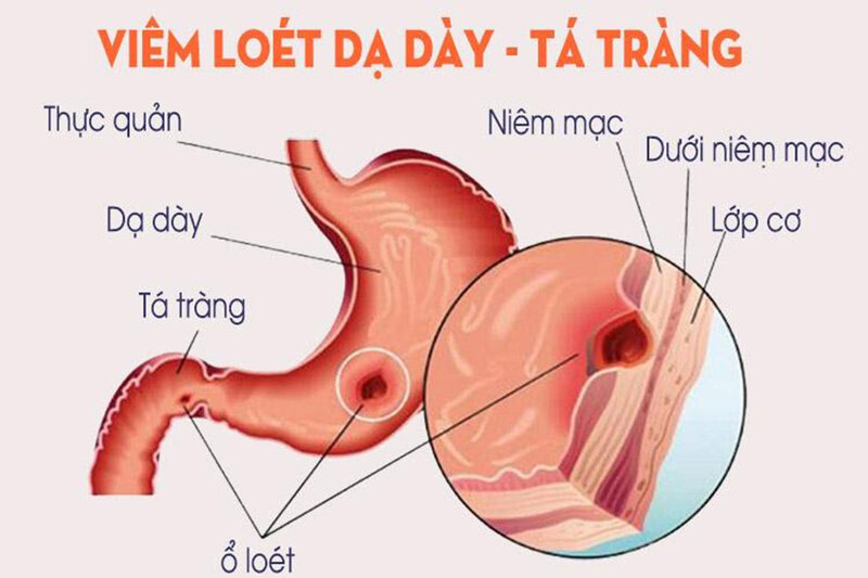 Viêm loét dạ dày tá tràng gây đau bụng kèm theo chán ăn, rối loạn tiêu hóa