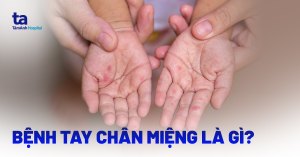 Trẻ phát ban ở tay, chân, miệng khi mắc bệnh