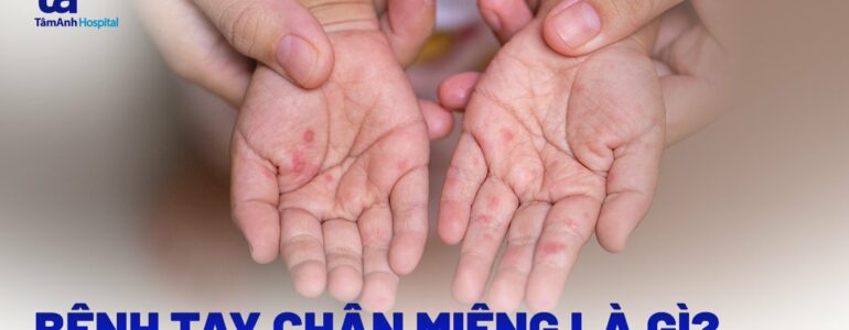 Bệnh tay chân miệng: Nguyên nhân, triệu chứng và cách chăm sóc