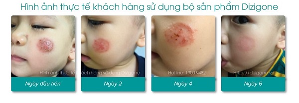 Dizigone trị chàm sữa cho bé