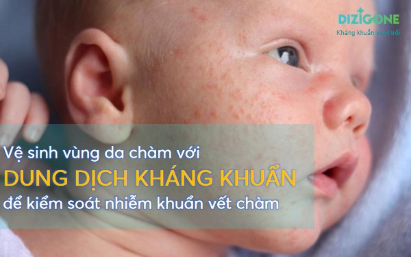 be-bi-cham-sua bé bị chàm sữa