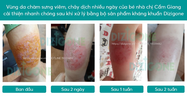 chàm sữa viêm da cơ địa cham-sua-viem-da-co-dia