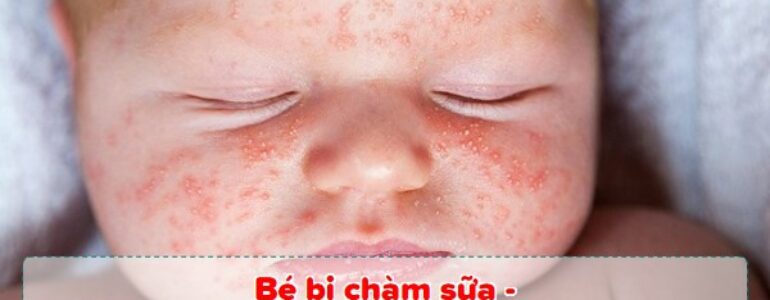 Bé bị chàm sữa - Mách mẹ 7 cách chữa nhanh nhất tại nhà - Dizigone