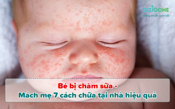 be-bi-cham-sua bé bị chàm sữa