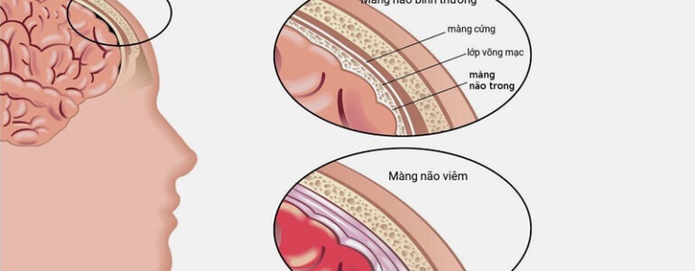 Nhận biết bệnh viêm màng não ở người lớn và cách điều trị | Medlatec