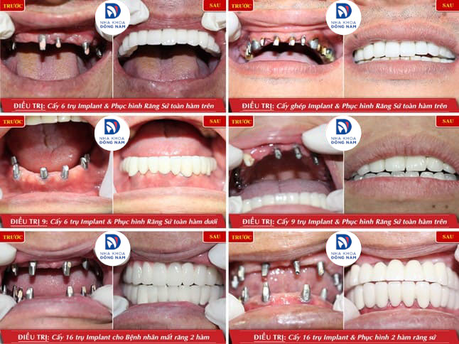 nhổ răng hàm dưới hết bao nhiêu tiền