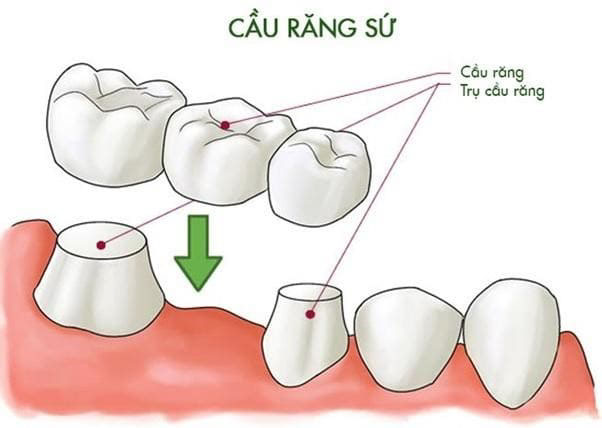 nhổ răng giá bao nhiêu tiền