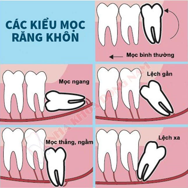 nhổ răng số 8 mọc lệch hết bao nhiêu tiền