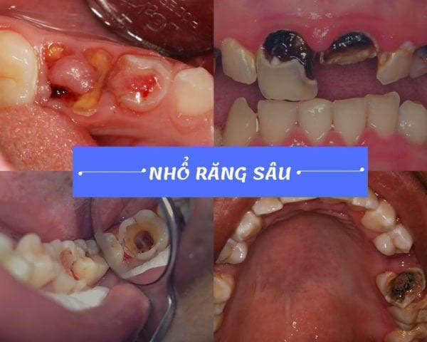 nhổ răng khôn số 8 bao nhiêu tiền