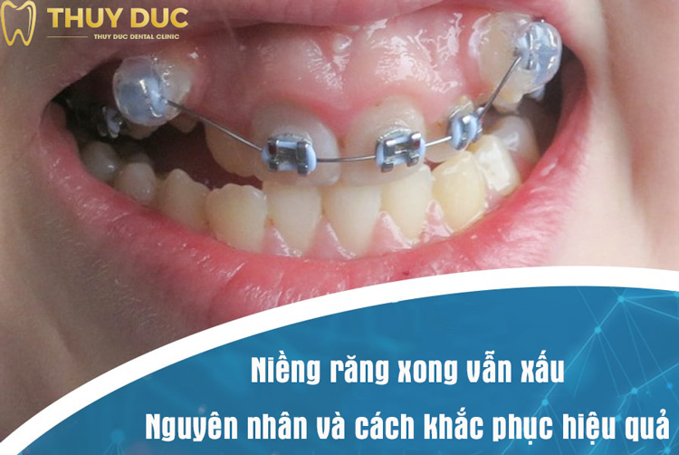 Vì sao niềng răng xong vẫn xấu? Có khắc phục được không? 1