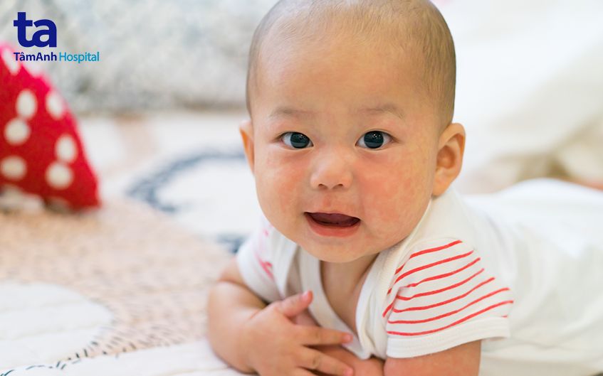 trẻ cần được tiêm vaccine ngừa sởi